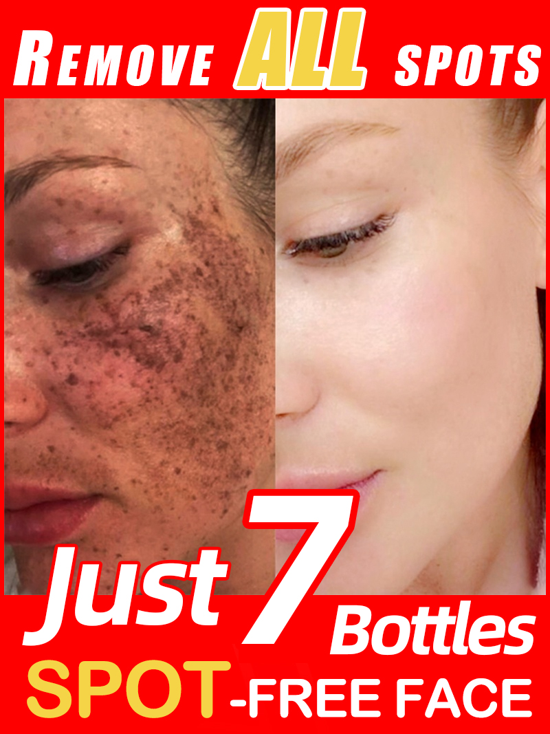 Lighten Freckles Melasma, Faci - Luxury Natural Skincare review and price